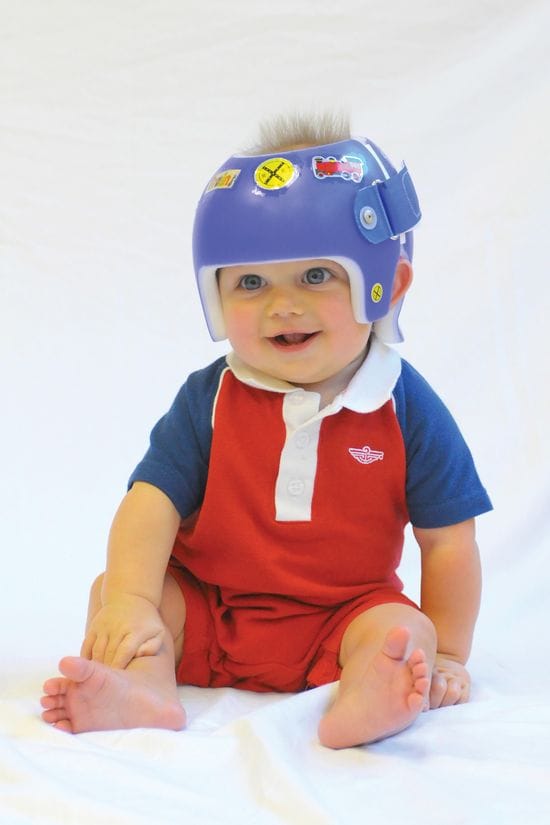 How a Plagiocephaly Helmet Can Help Your Baby